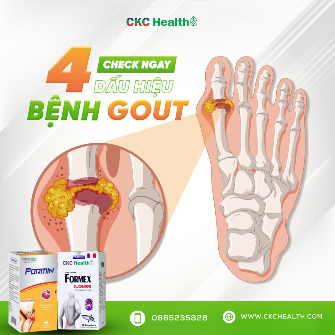 CẢNH BÁO: 4 DẤU HIỆU GOUT KHÔNG ĐƯỢC BỎ QUA!